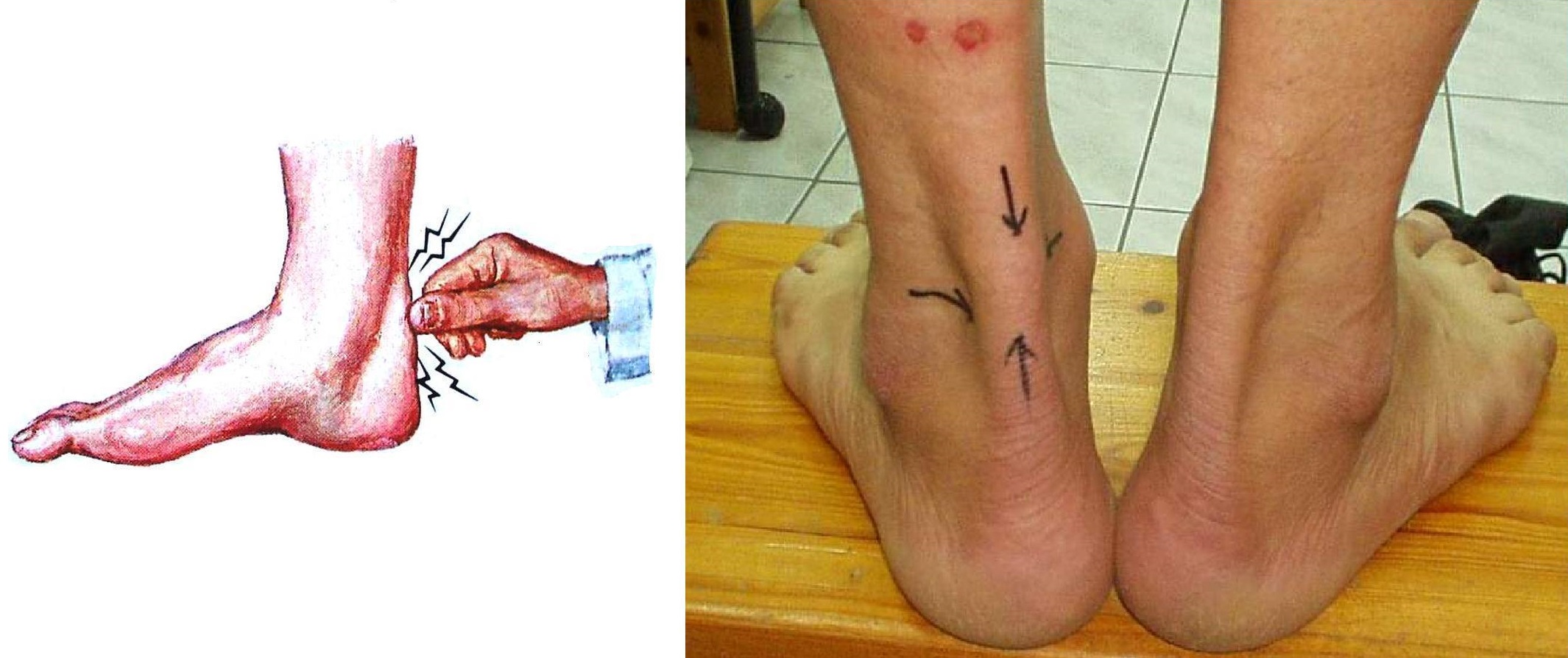 Tendon_aquiles