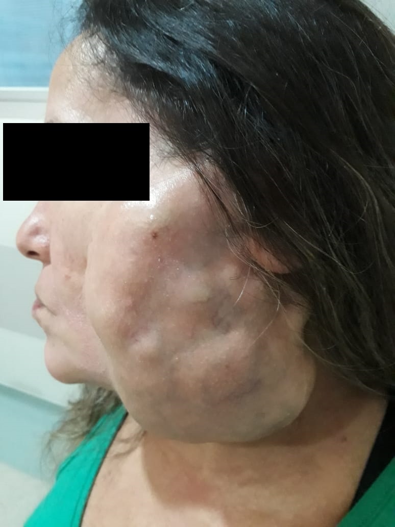 tumor